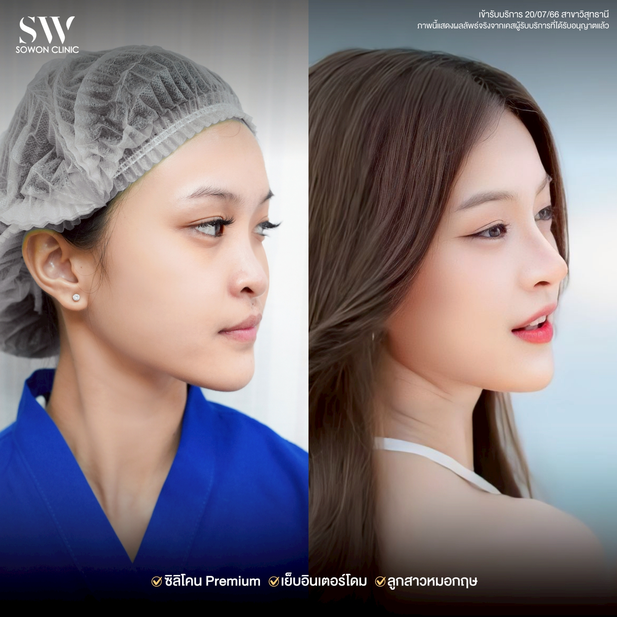 ทรงจมูก รีวิวลูกสาว Sowon Clinic01