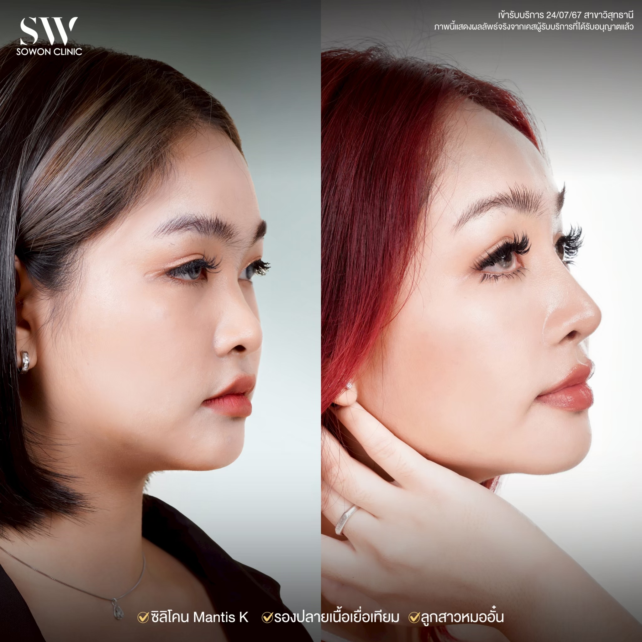 ทรงจมูก รีวิวลูกสาว Sowon Clinic10