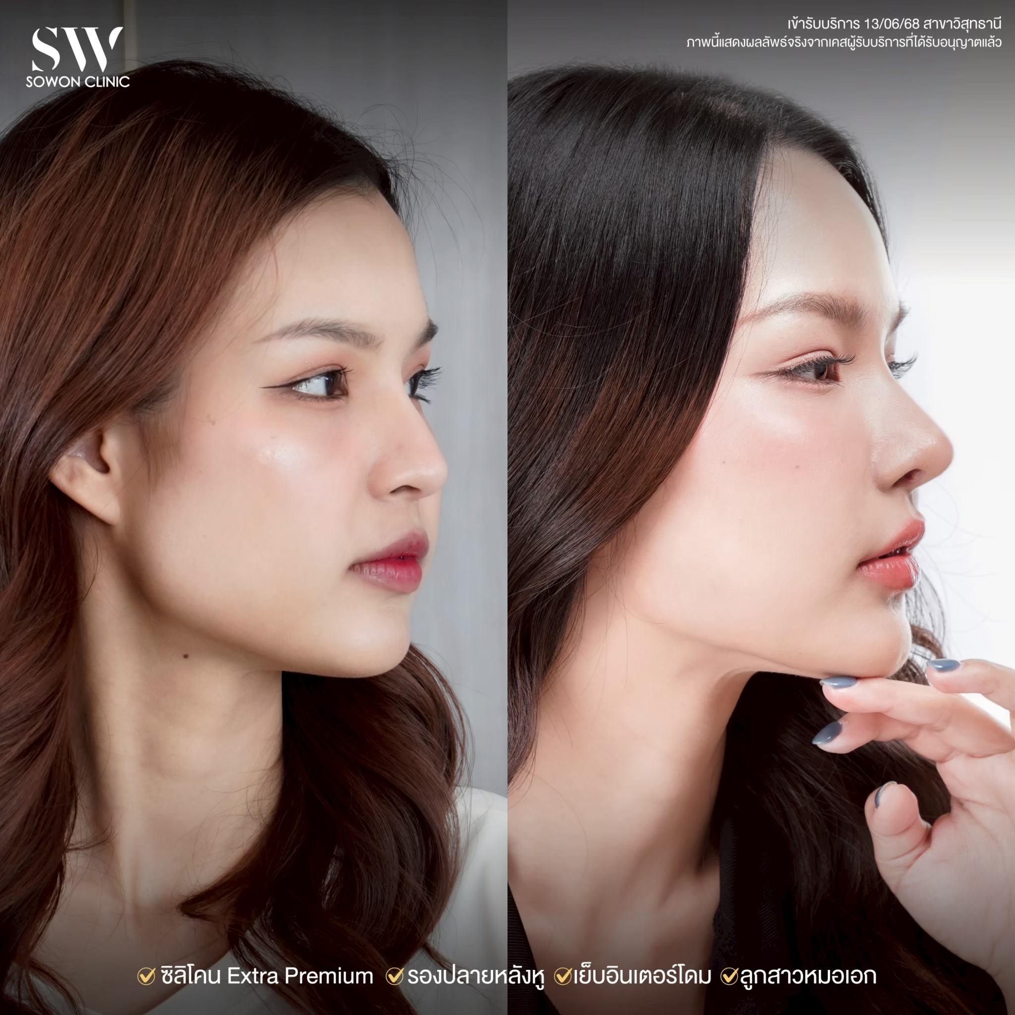 ทรงจมูก รีวิวลูกสาว Sowon Clinic9