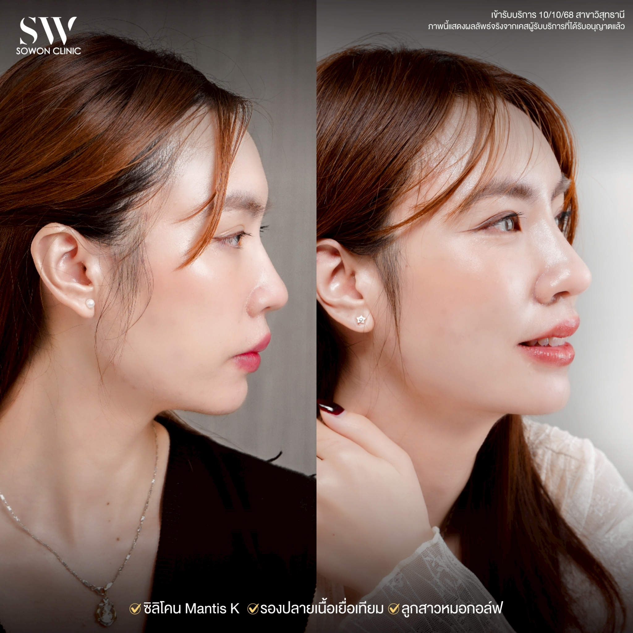 ทรงจมูก รีวิวลูกสาว Sowon Clinic8