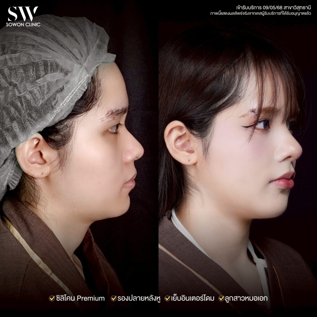 ทรงจมูก รีวิวลูกสาว Sowon Clinic7