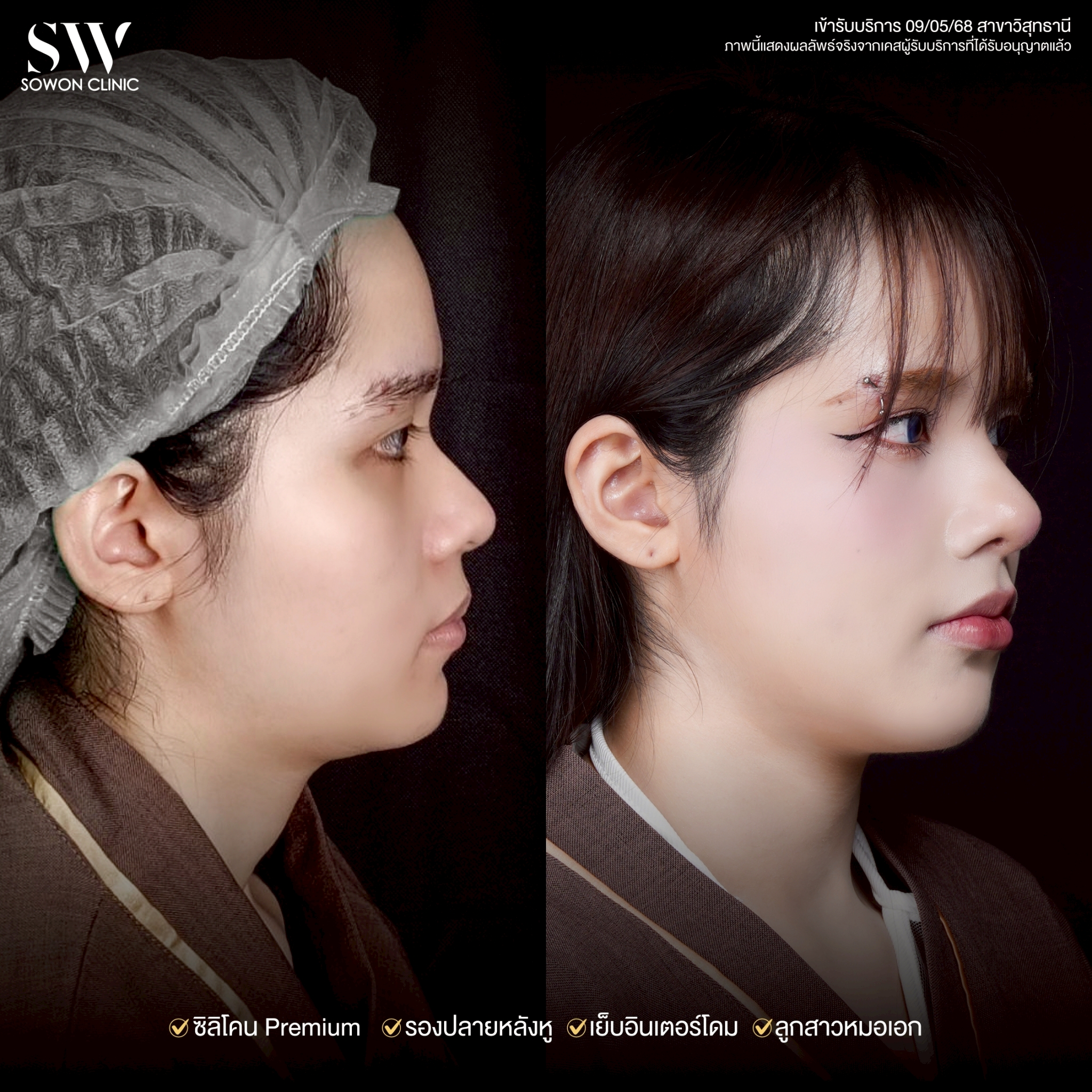 ทรงจมูก รีวิวลูกสาว Sowon Clinic7