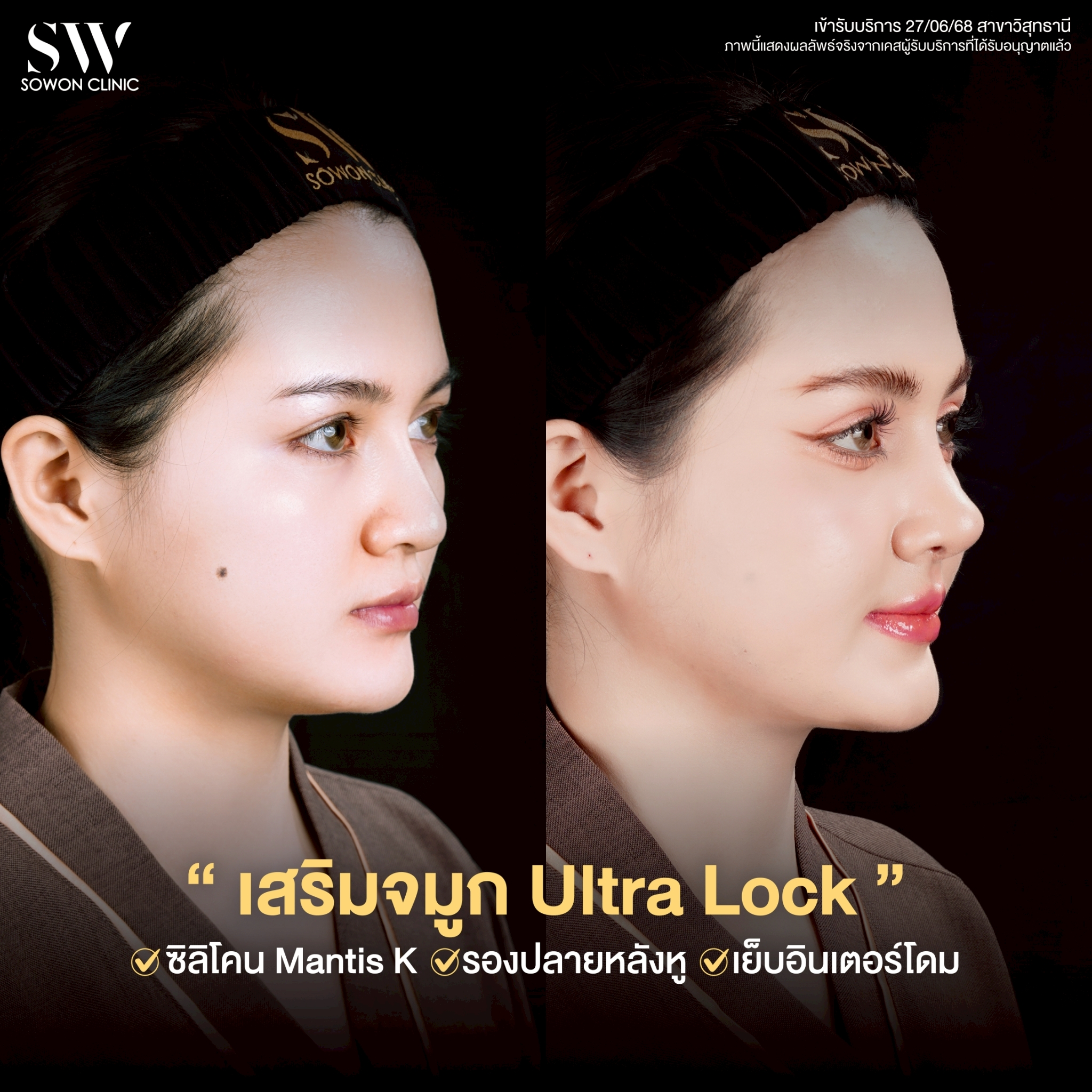 ทรงจมูก รีวิวลูกสาว Sowon Clinic6