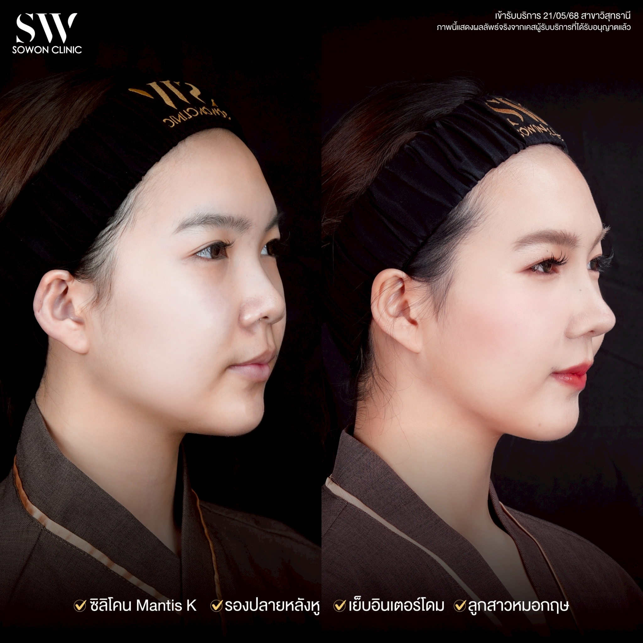 ทรงจมูก รีวิวลูกสาว Sowon Clinic4