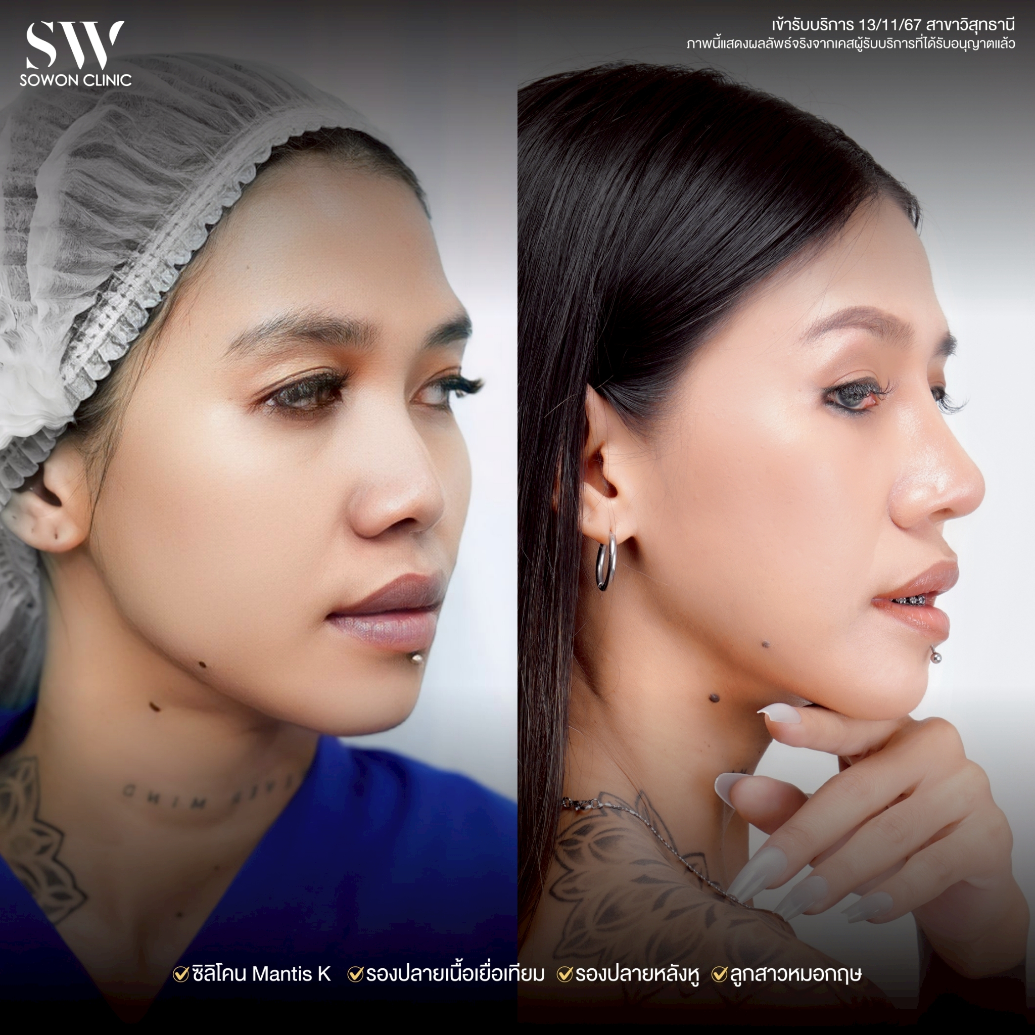 ทรงจมูก รีวิวลูกสาว Sowon Clinic3
