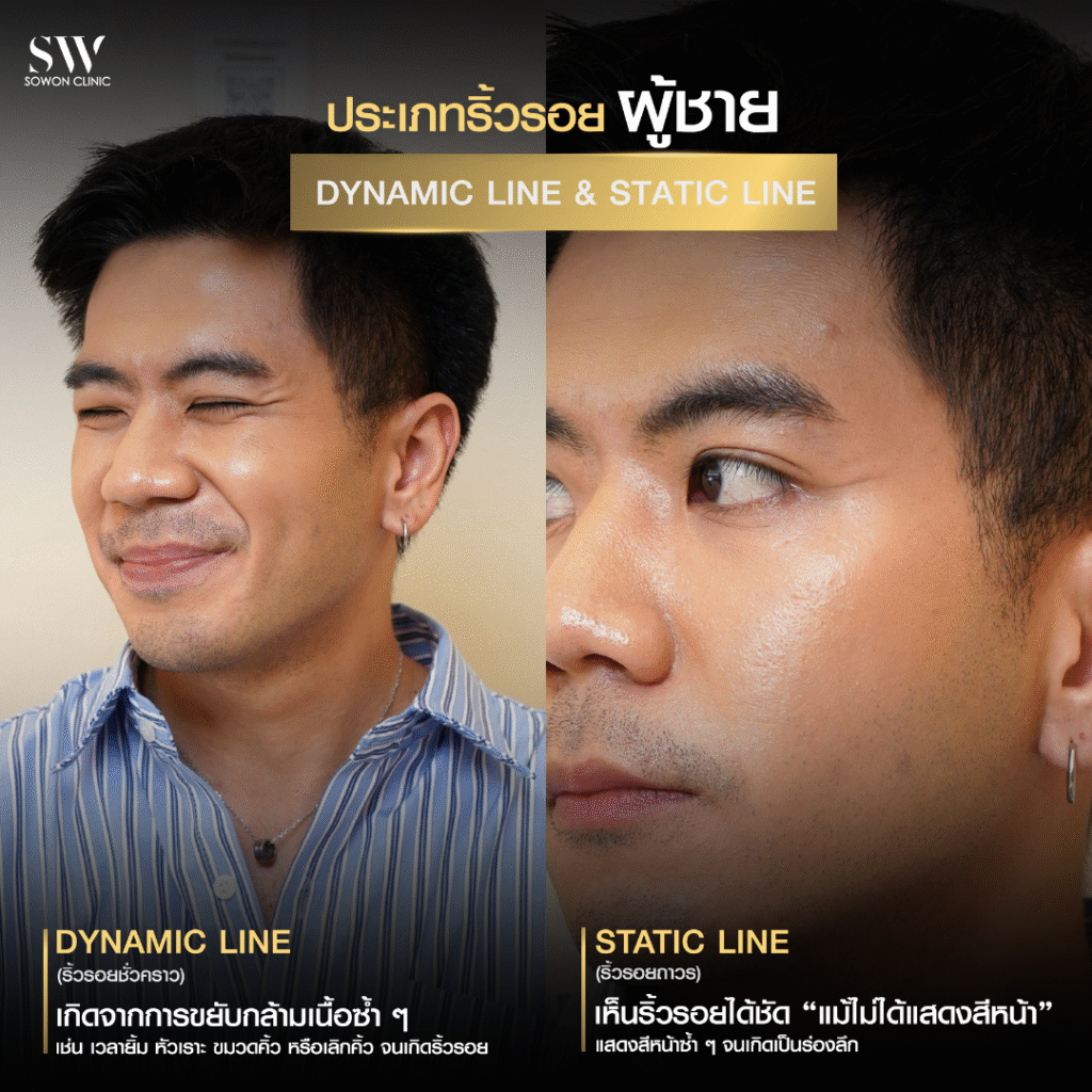 ริ้วรอย ประเภท