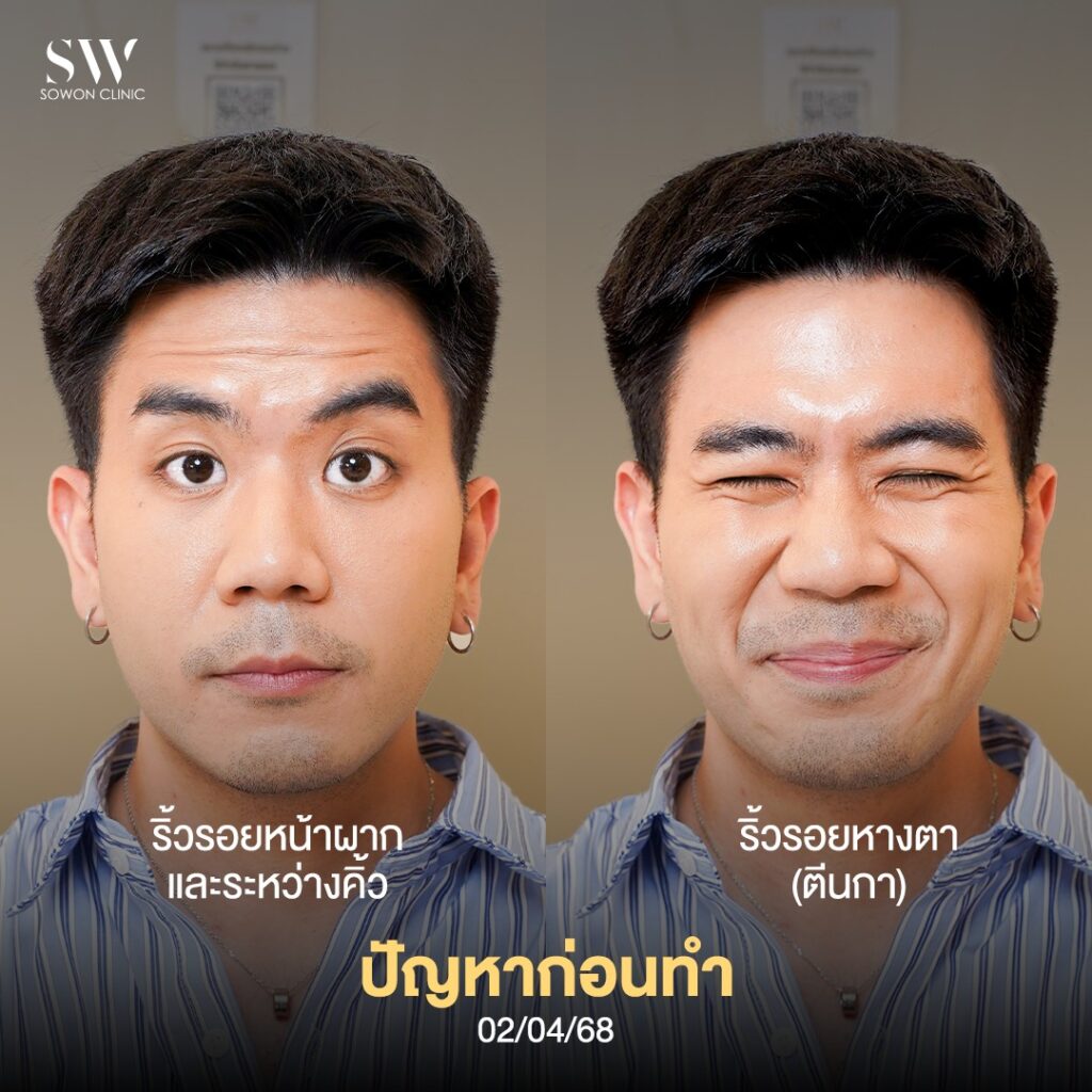 ริ้วรอย ฉีดบริเวณไหน