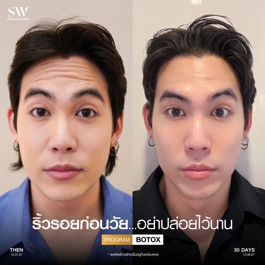 ริ้วรอย ฃโบ