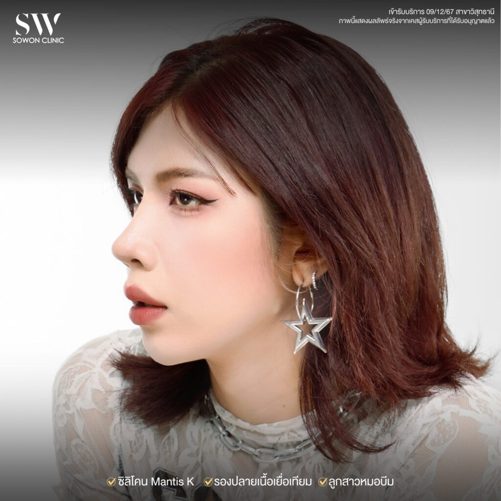 รีวิวเสริมจมูก รีวิว01