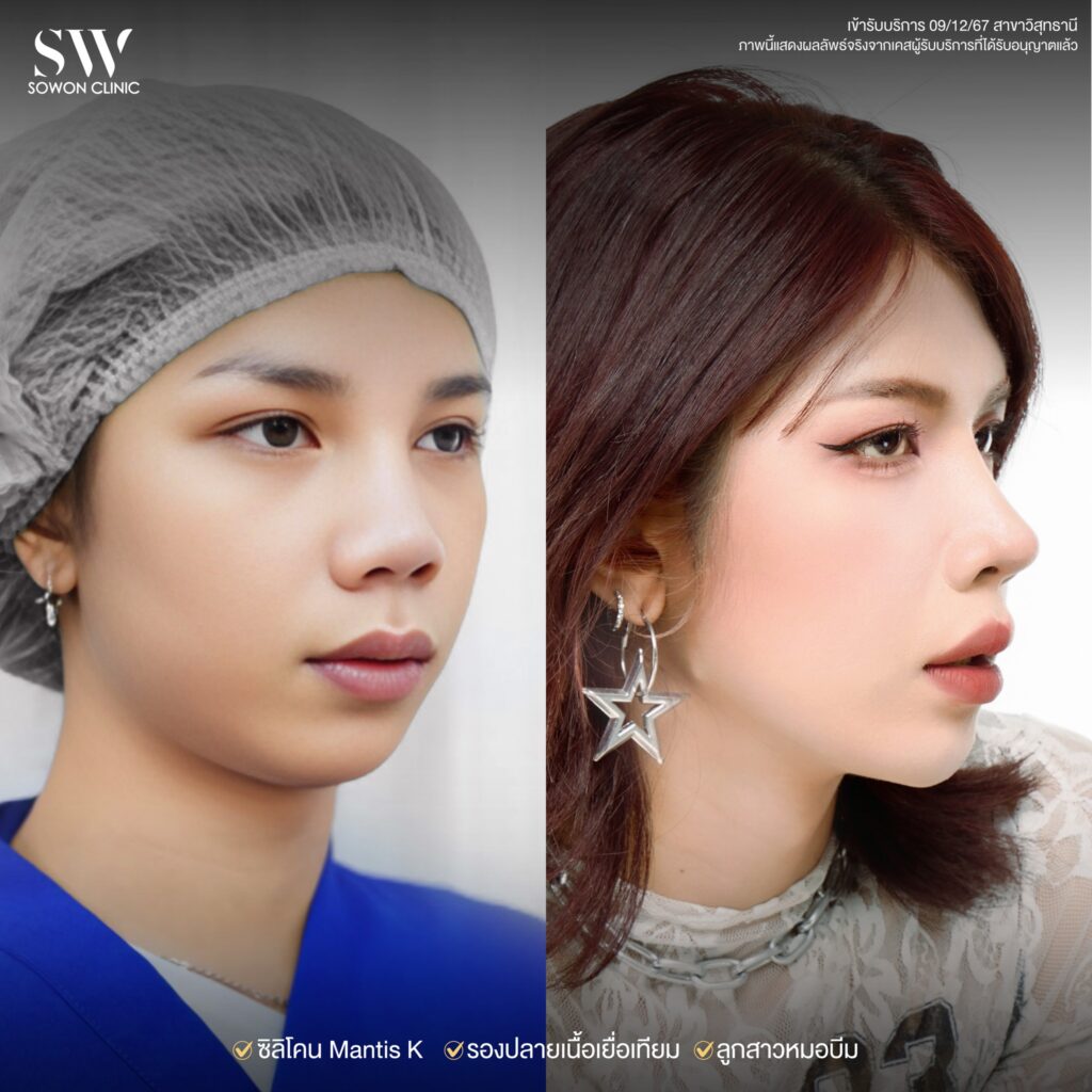 รีวิวเสริมจมูก รีวิว03