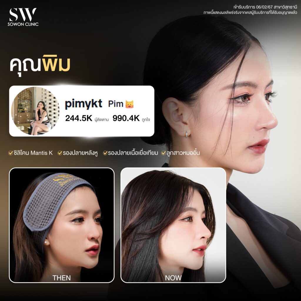 รีวิวเสริมจมูก 001