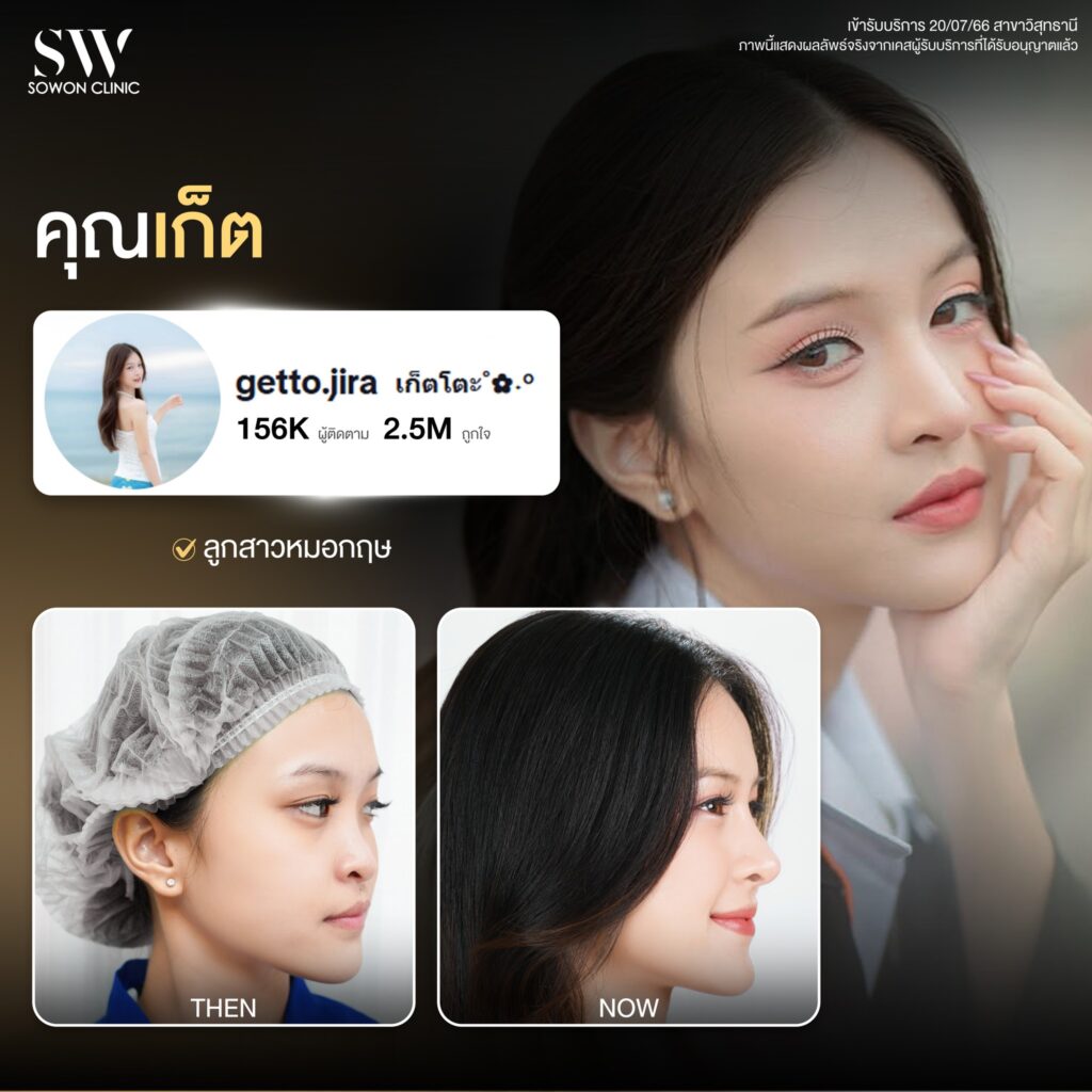 รีวิวเสริมจมูก 002