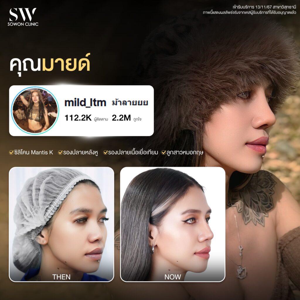รีวิวเสริมจมูก 003