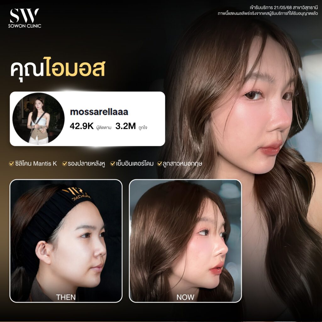 รีวิวเสริมจมูก 005