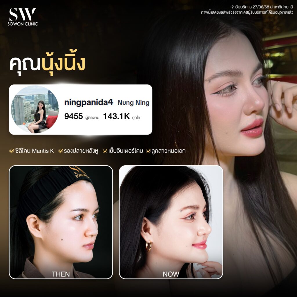 รีวิวเสริมจมูก 006