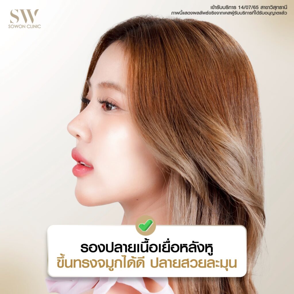 รีวิวเสริมจมูก 009