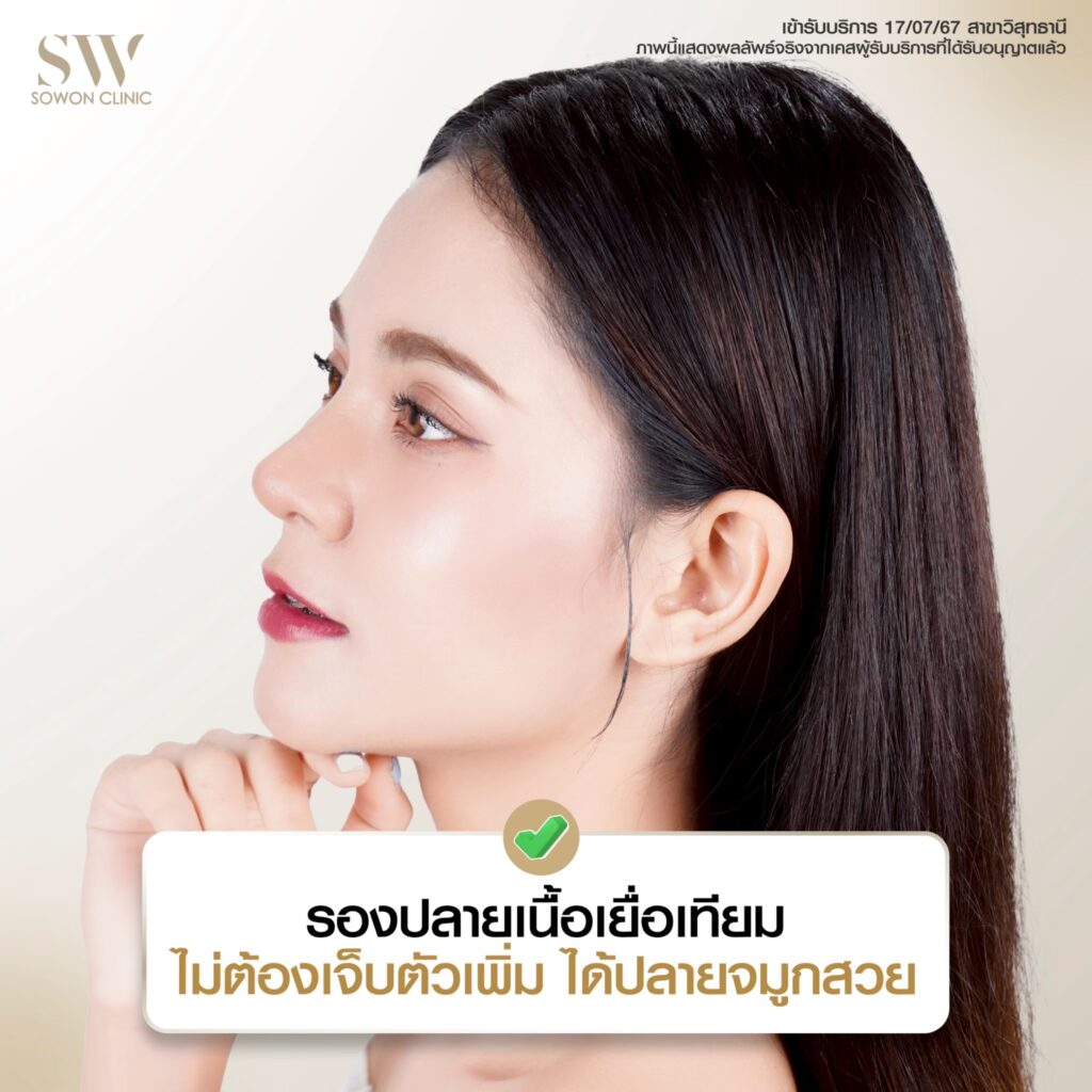 รีวิวเสริมจมูก 010