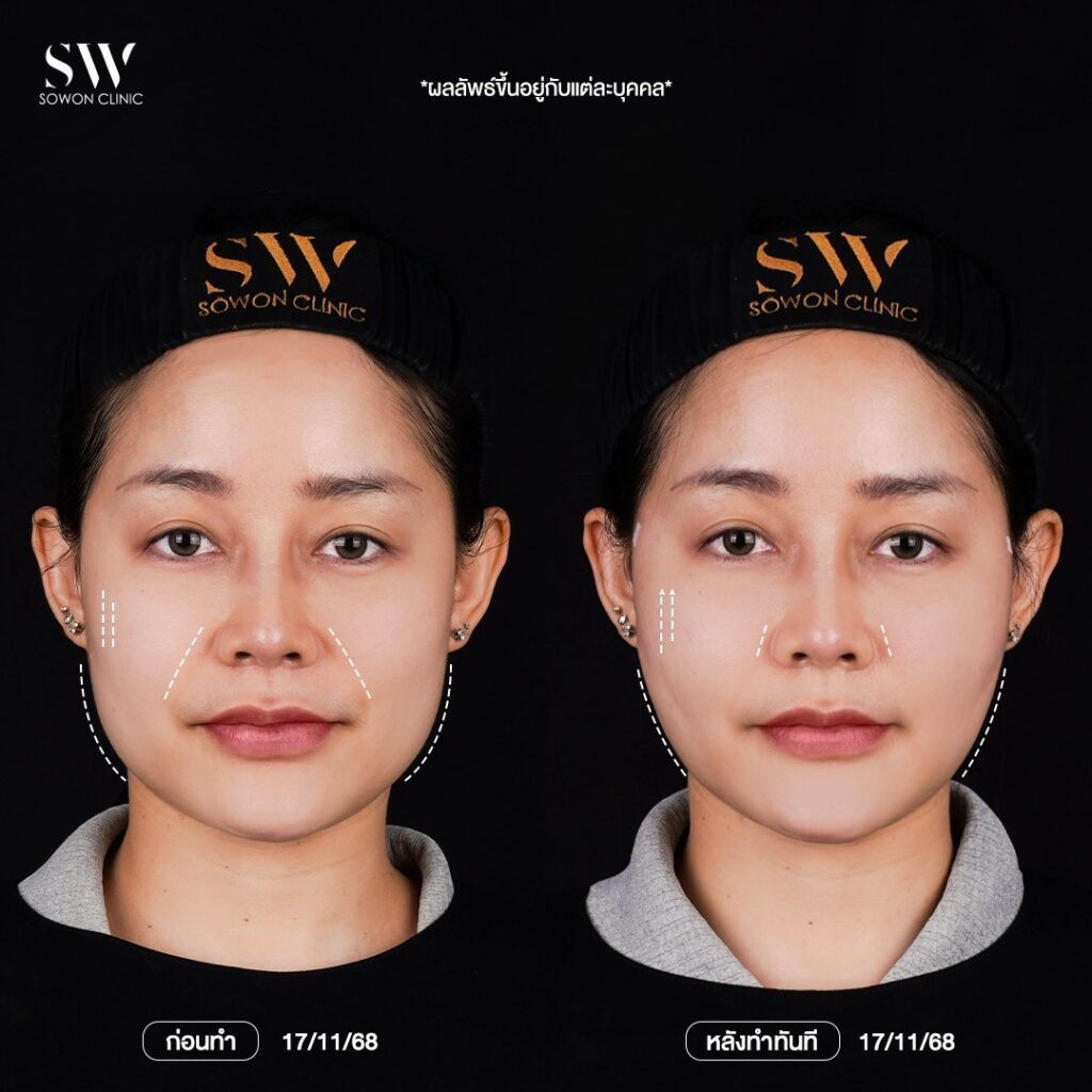 ร้อยไหม 004