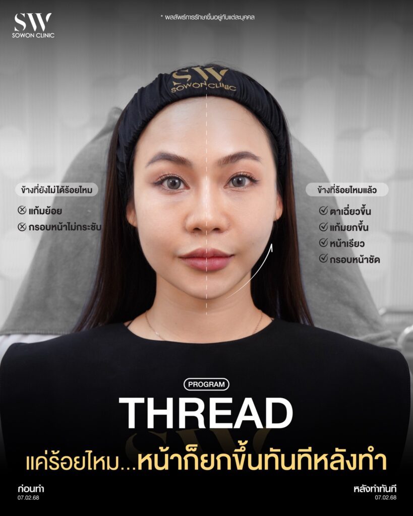 ร้อยไหม 009