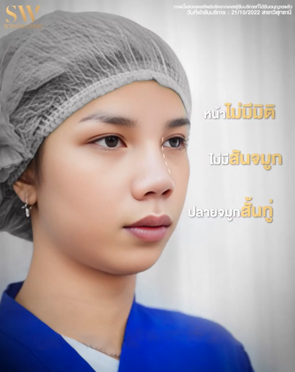 รีวิวเสริมจมูก ก่อนทำ