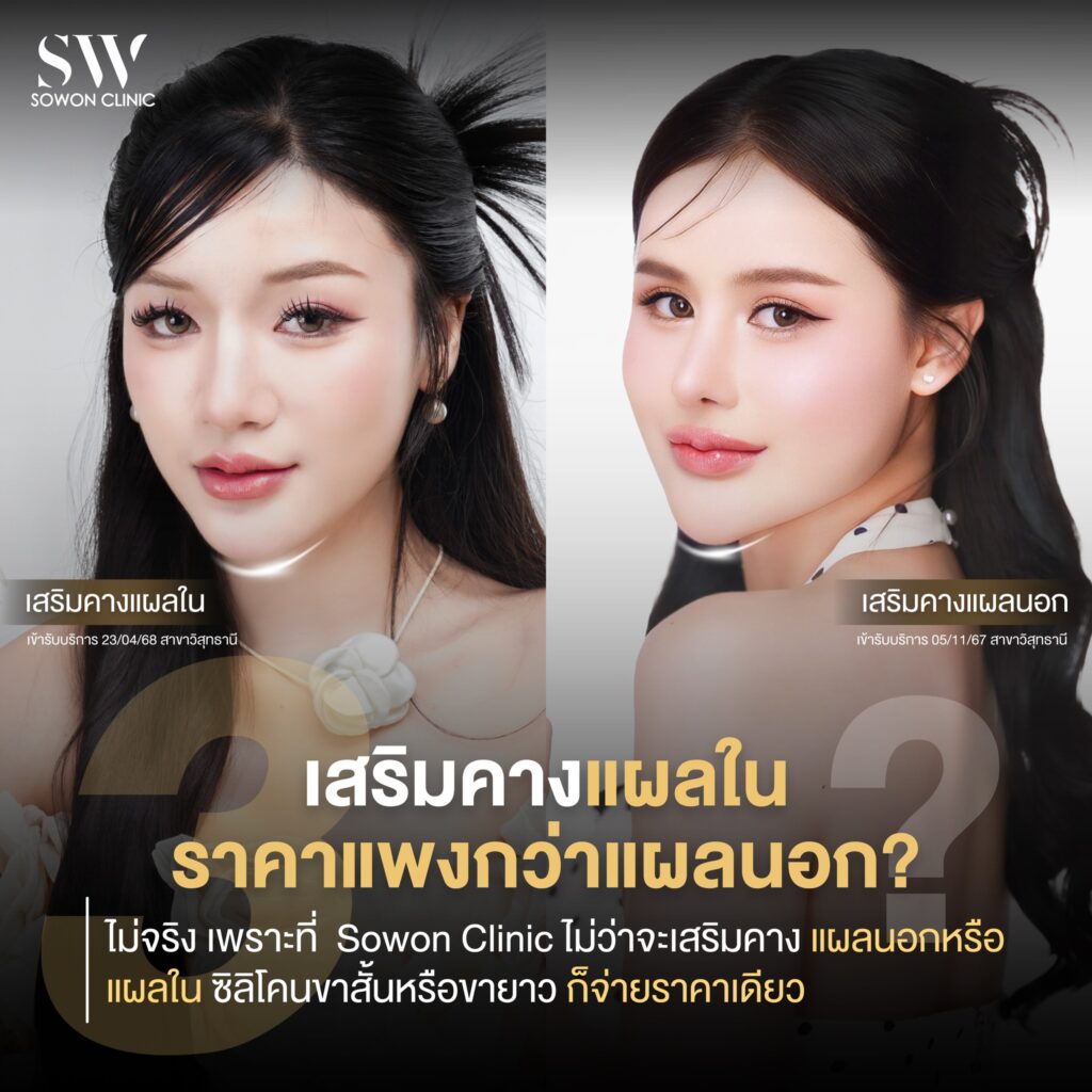 เสริมคาง005