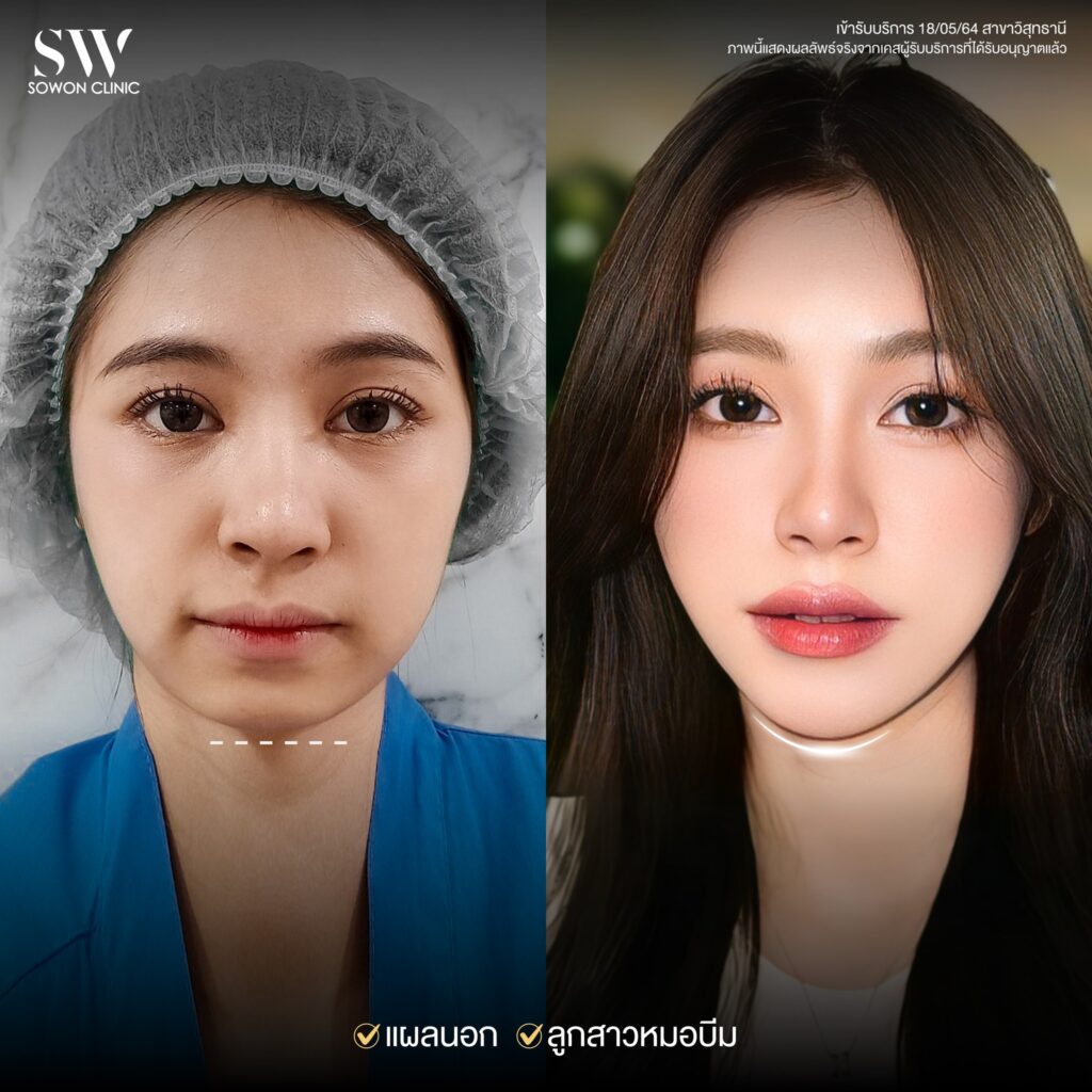 เสริมคาง007