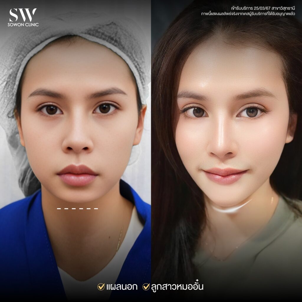 เสริมคาง008