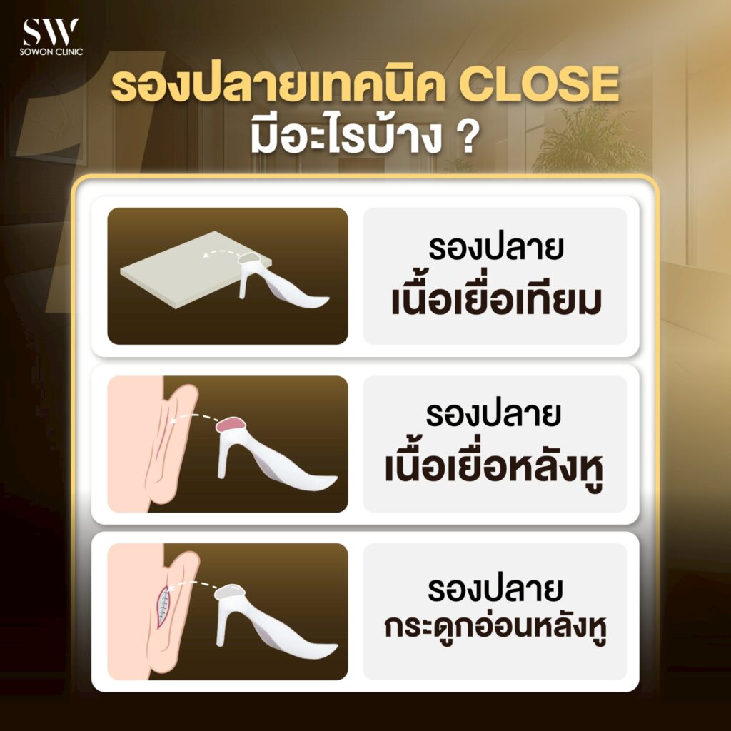 เสริมจมูกครั้งแรกต้องรู้อะไรบ้าง_รองปลายเทคนิค close