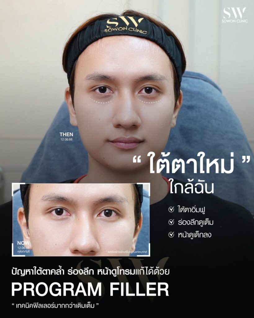ใต้ตาลึก_ฟิลเลอร์ใต้ตา_ปัญหา