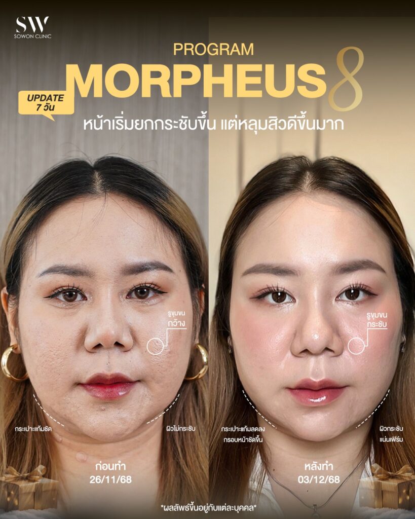 Morpheus8 0002