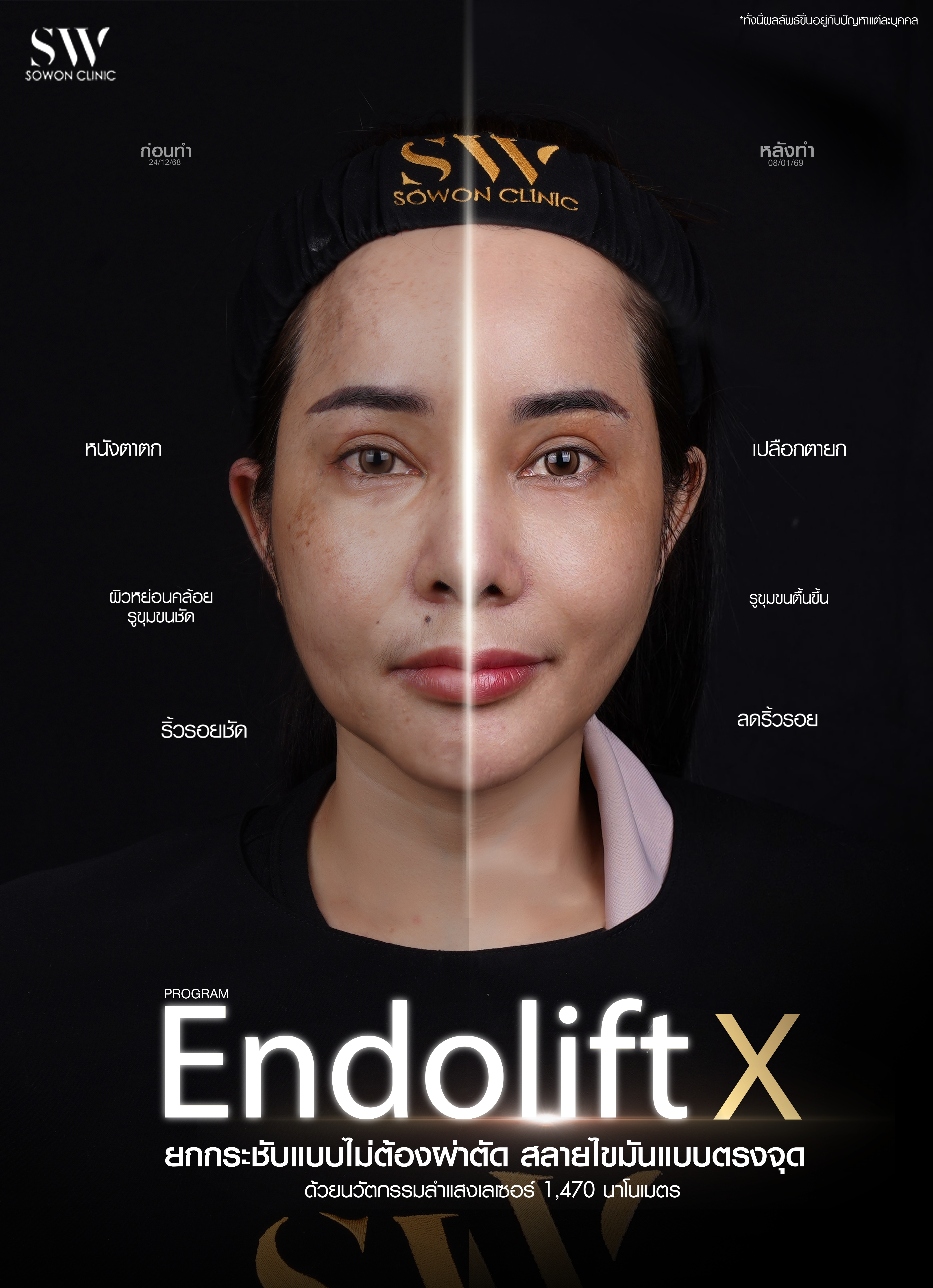 endolift x_AW