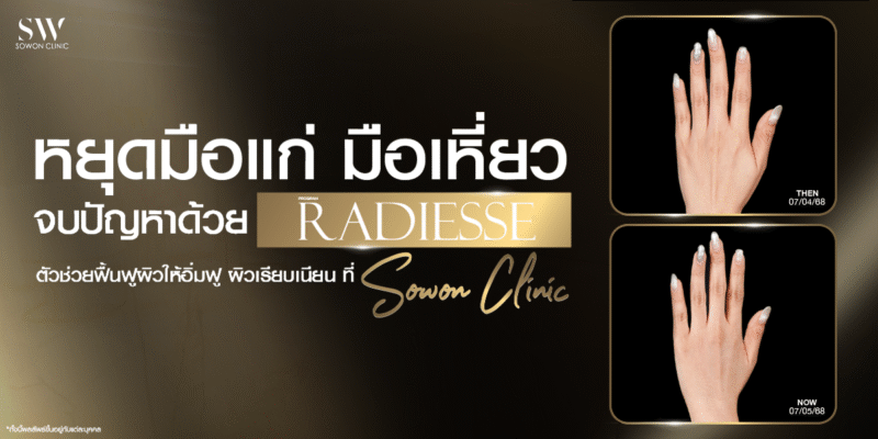 radiesse-hand-rejuvenation_skin-filler_knowledge