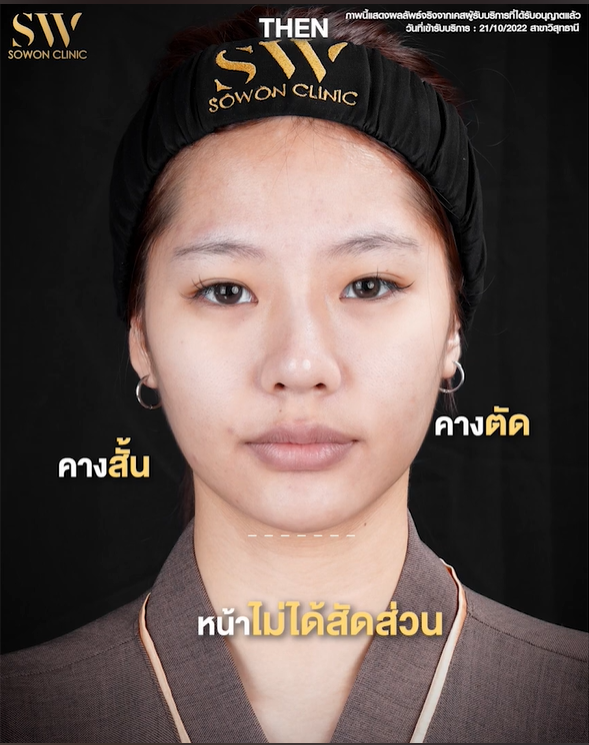 รีวิวเสริมคาง -review-chin01