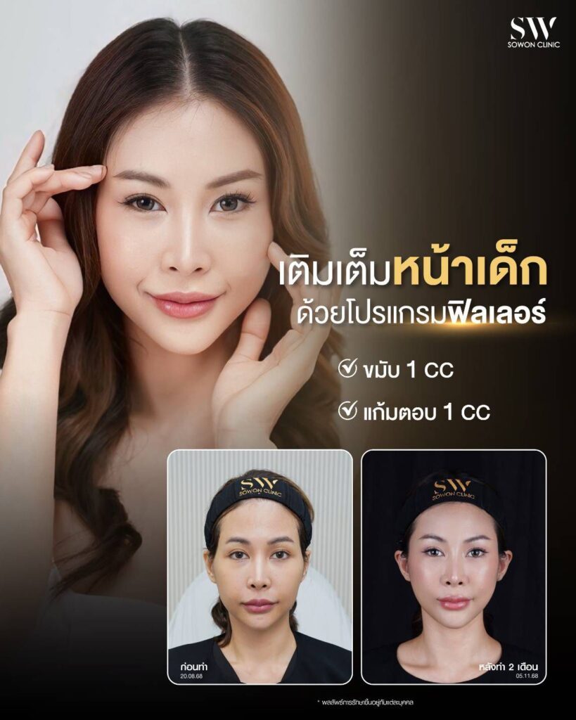 ฟิลเลอร์ 001