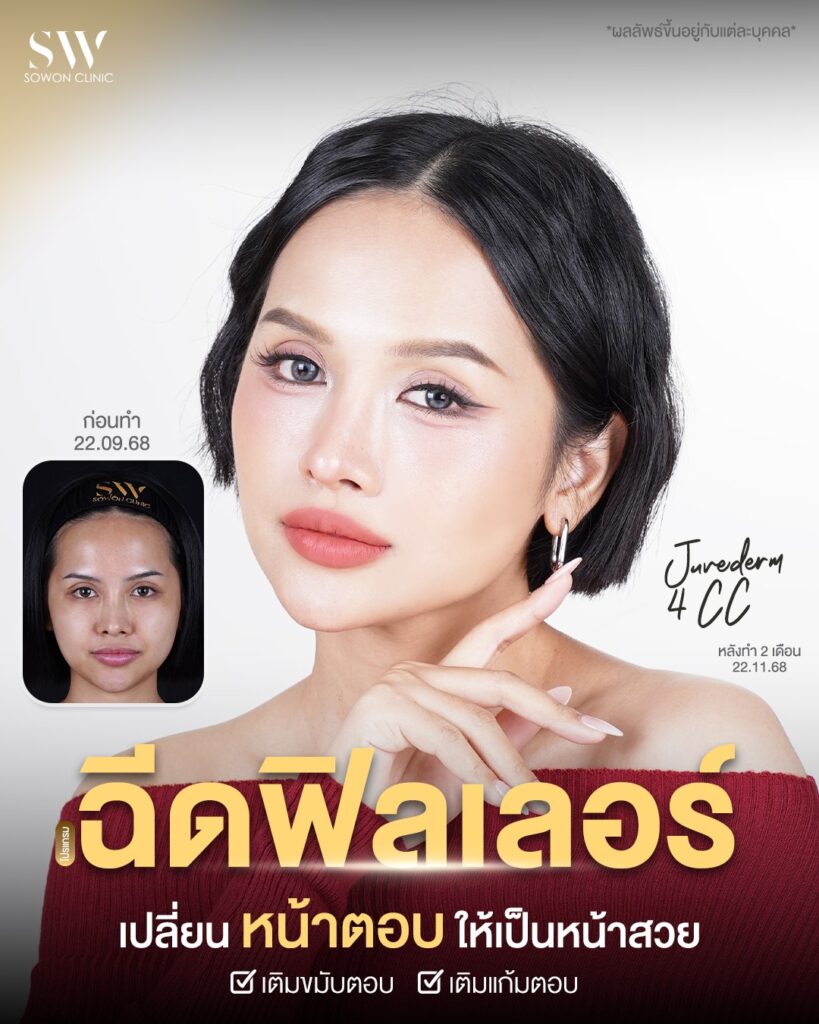 ฟิลเลอร์ 003