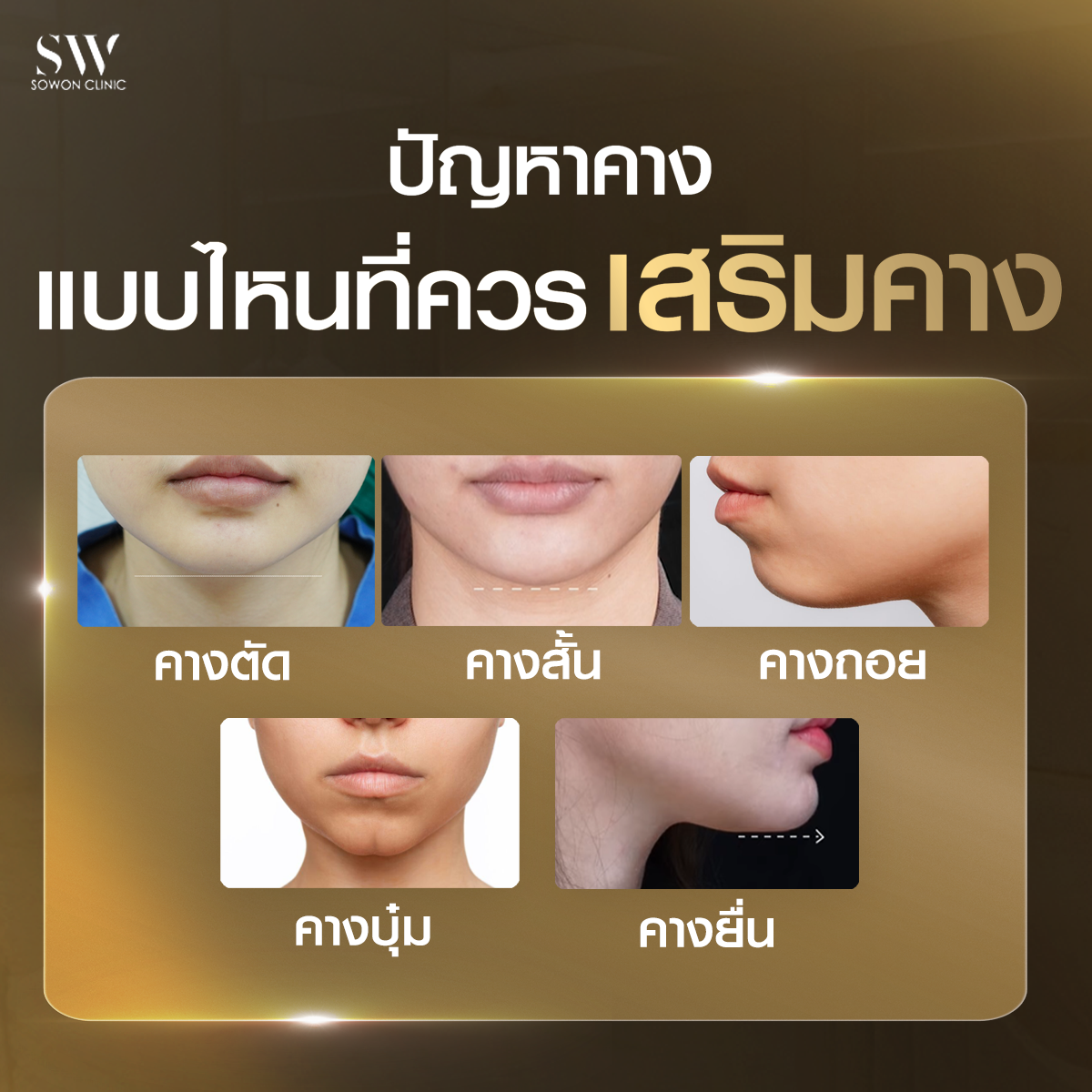 ปัญหาคางแบบไหนที่ควรเสริม