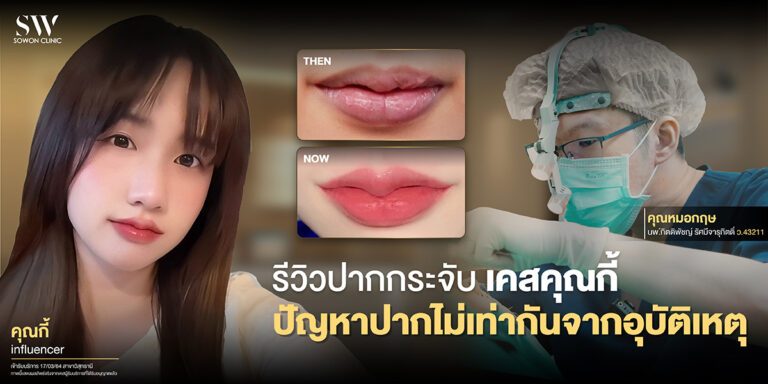 cupid-lip-revision-case-surgery-lip-review