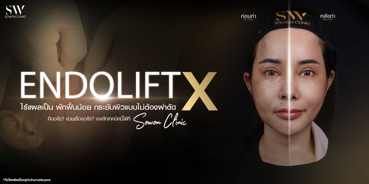 endolift-x-non-surgical-face-lift-skin-endoliftx-knowledge endolift-x-non-surgical-face-lift-skin-endoliftx-knowledge