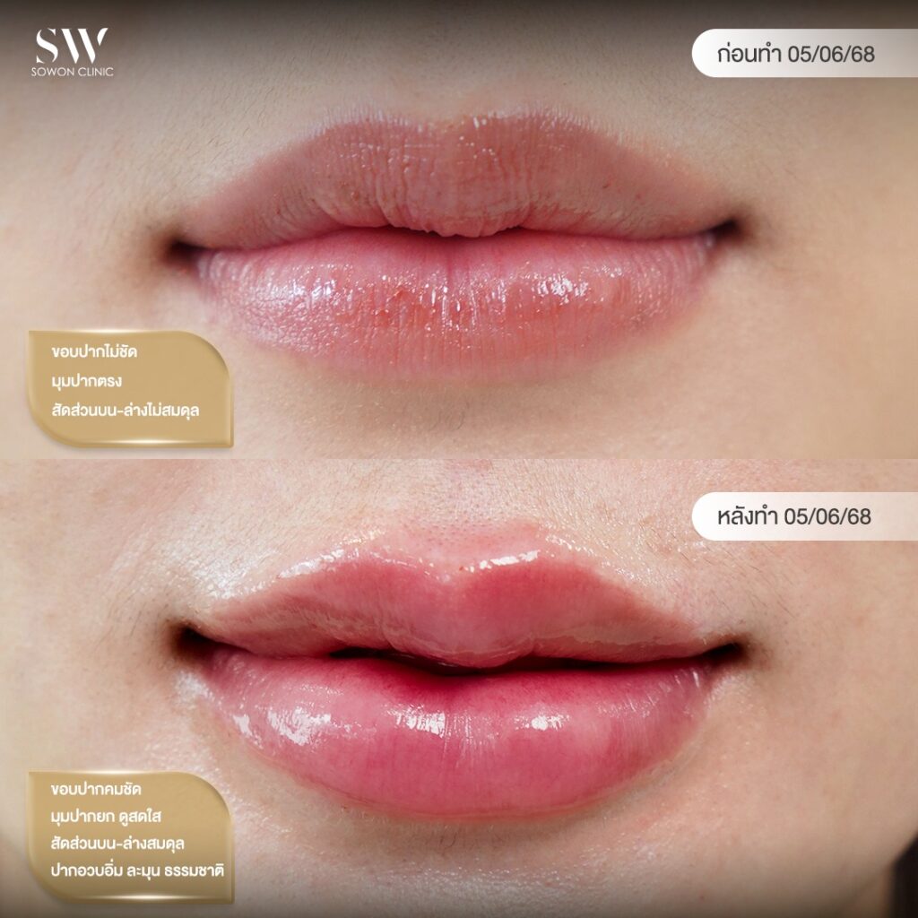 ฟิลเลอร์ คุณมะปราง 02