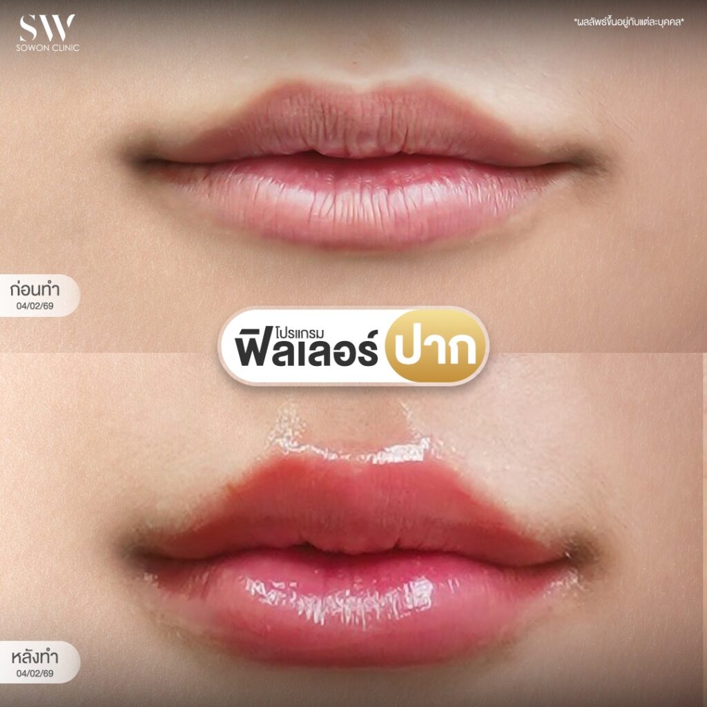 ฟิลเลอร์ปาก 01