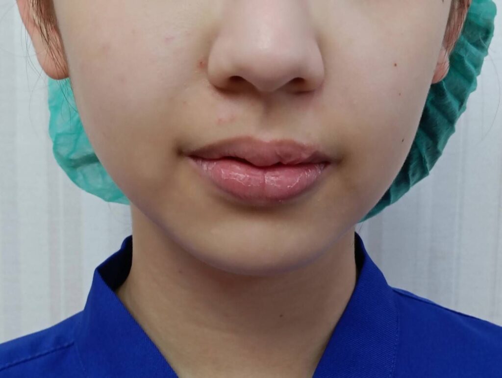 ฟิลเลอร์ปาก คุณมะปราง 06