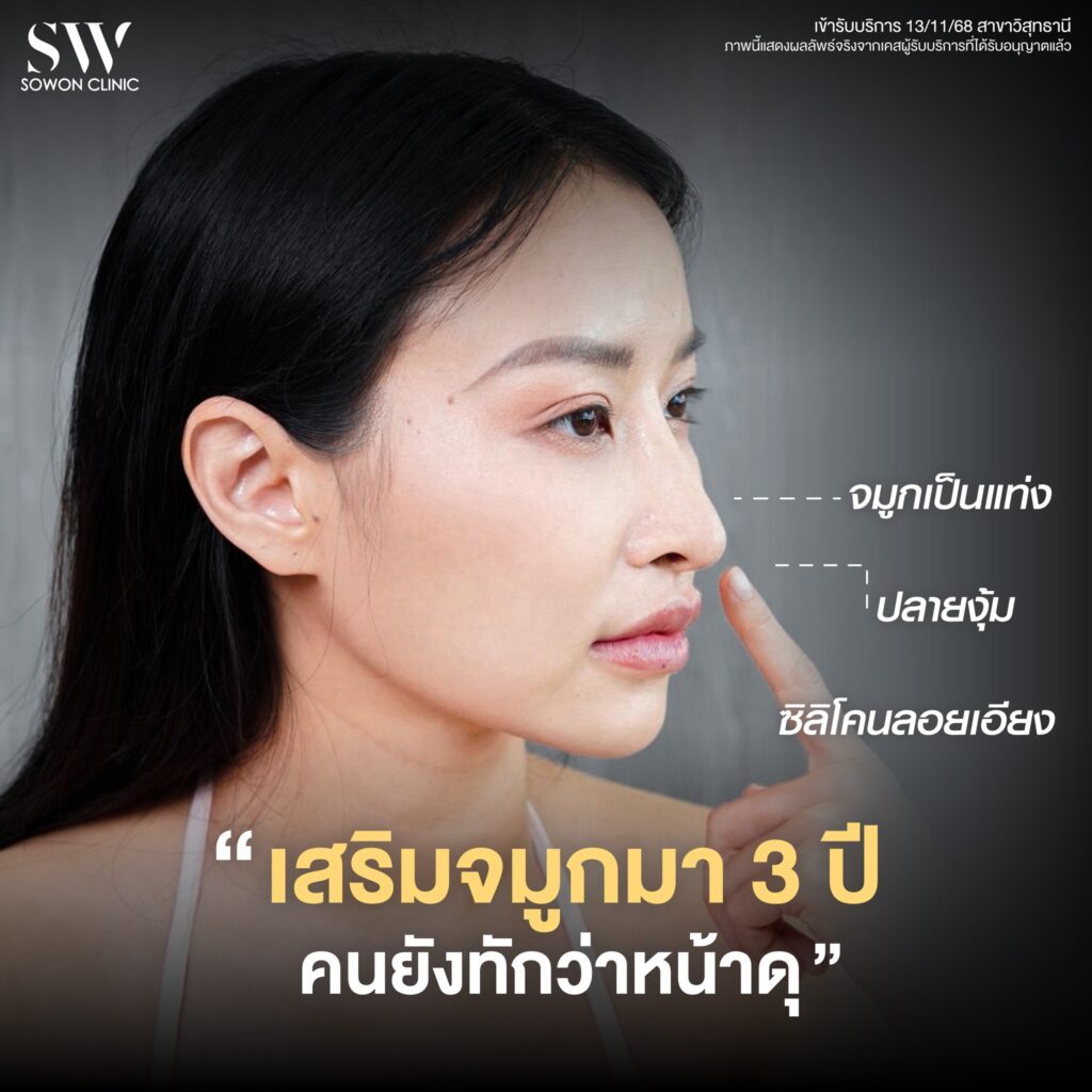 รีวิวเสริมจมูก คุณแอปเปิ้ล 02