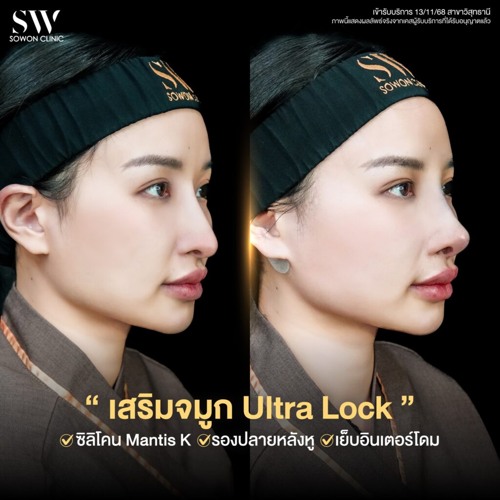 รีวิวเสริมจมูก คุณแอปเปิ้ล 03