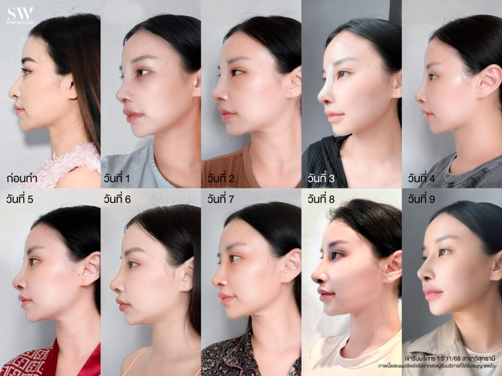 รีวิวเสริมจมูก คุณแอปเปิ้ล 06