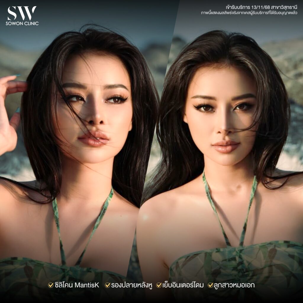 รีวิวเสริมจมูก คุณแอปเปิ้ล 07