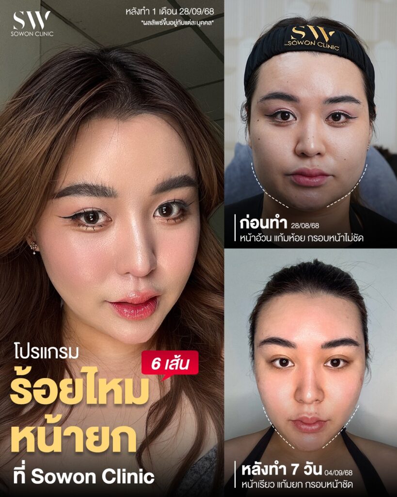 ร้อยไหม 03