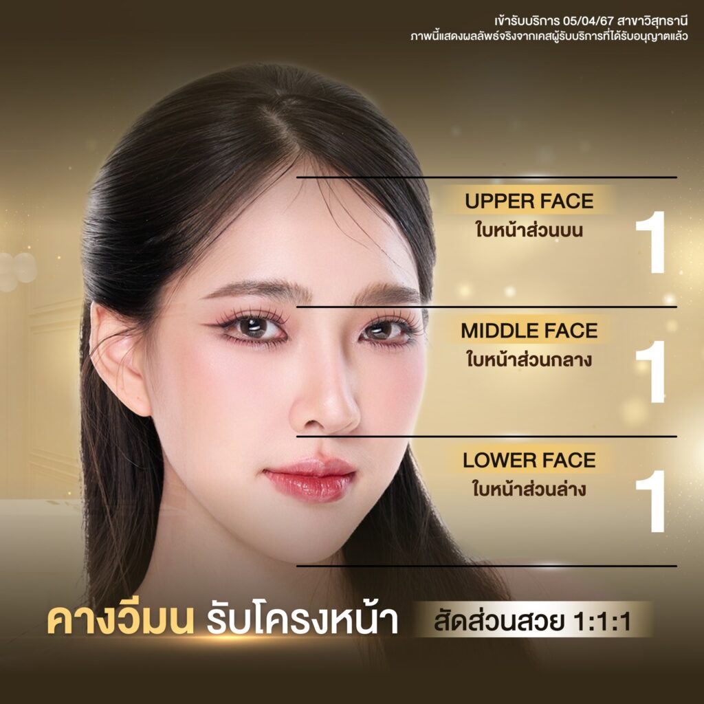 เสริมคาง 04