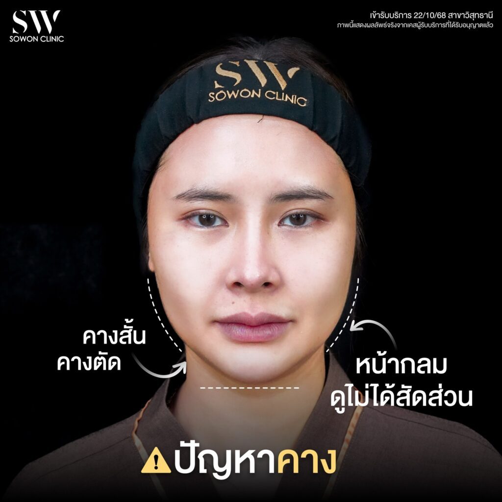 เสริมคาง 05