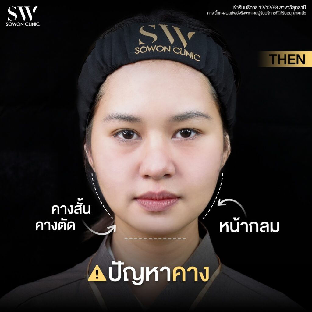 เสริมคาง 06