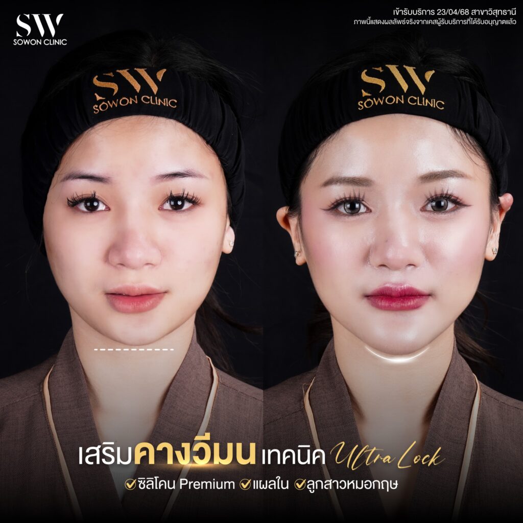 เสริมคาง 08